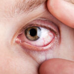 Ocular Surface Disease