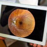 Retinal Disorders